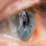Who Is a Good Candidate for Refractive Lens Exchange