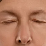 LASIK Side Effects: What You Need to Know